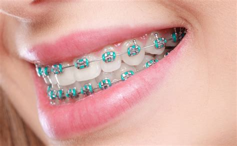 Types of dental braces for adults - Voss Dental Houston, TX