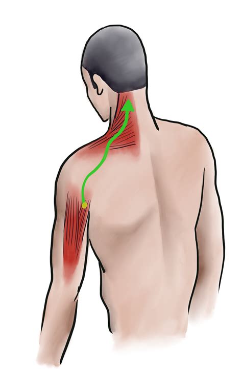 Acupuncture for Neck Pain (Part 2)