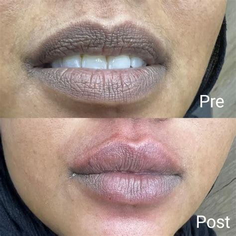 Lip augmentation in Hurghada - Book now - Nadara Center