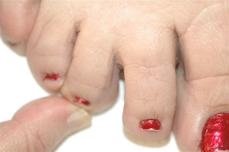 What Causes Your Toe To Turn Purple at Susan Lebrun blog