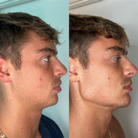 Facial Contouring Jaw at Krista Guerrero blog
