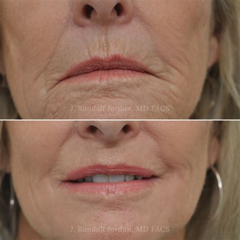 Deep Chemical Peel Jackson, MS | Faces, PLLC