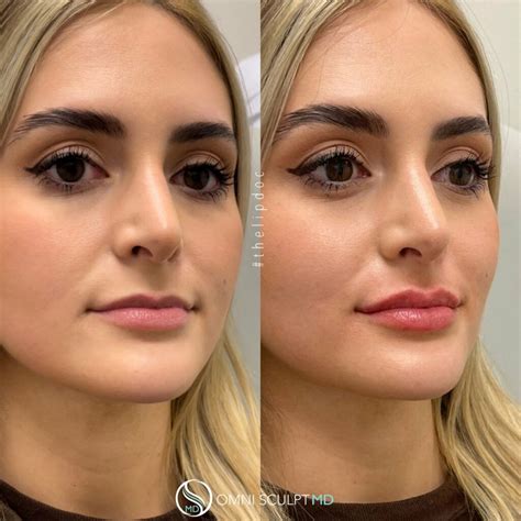 Lip injections – Artofit