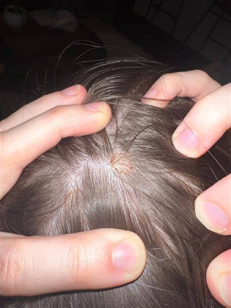 2 moles? On scalp : r/Melanoma