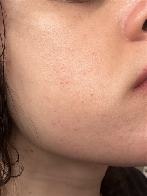 Red dots on face? : r/DermatologyQuestions