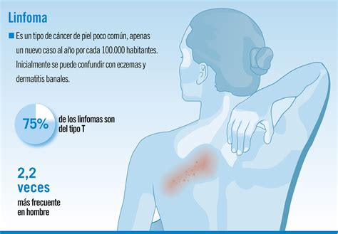 Linfoma cutáneo: conoce sus síntomas