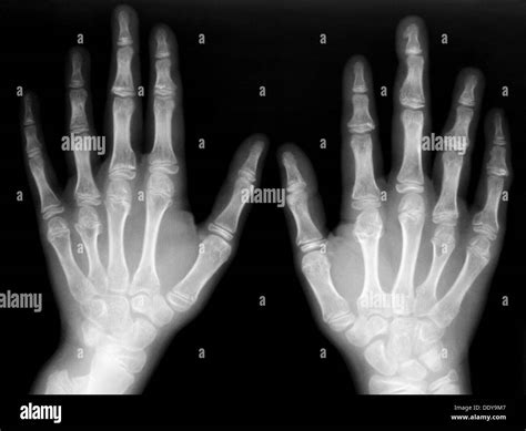 Hand bones hi-res stock photography and images - Alamy