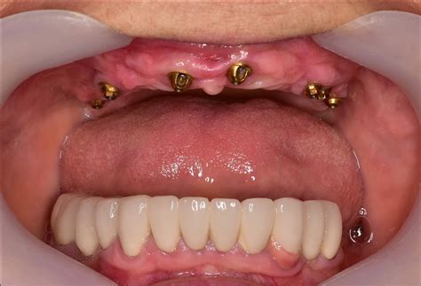 Fixed Implant Denture - Athens, GA | Watkinsville, GA — Hall Dental