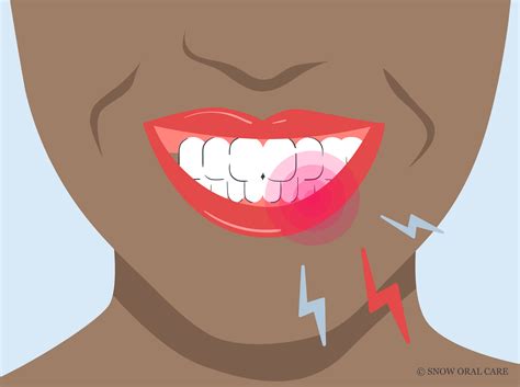 Tooth Zingers After Whitening at Chastity Dowling blog