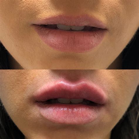 Diy Lip Injections