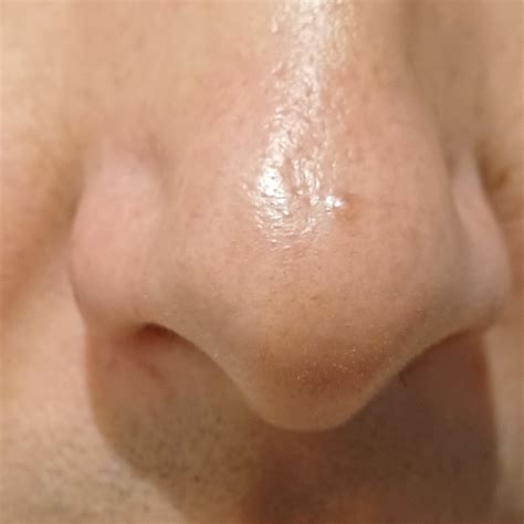 Flesh Colored Bump On Nose