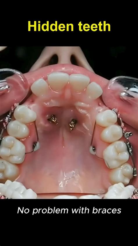 Best 13 Benefits of Invisalign that will help you to choose Invisible Braces – Artofit