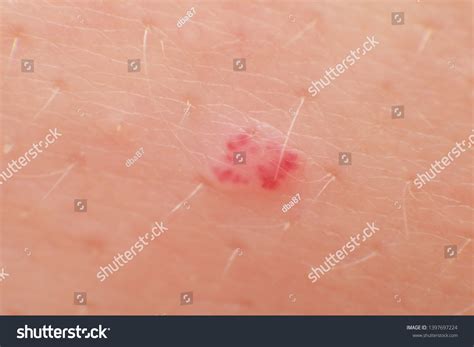 Cherry Angioma Growing at Sandra Gabrielson blog