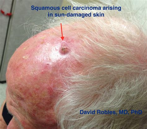Albums 92+ Pictures Photos Of Melanoma On Scalp Latest