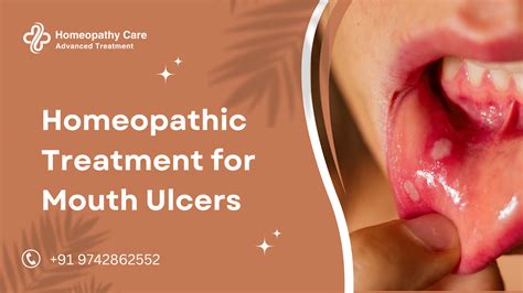 Homeopathic Treatment for Mouth Ulcers - Homeopathy Care