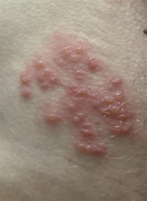 What are these bumps? On buttocks so though it could be butt acne (( which I never got before so ...