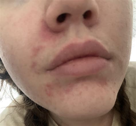 Why are the areas around my (F21) mouth breaking out? It has looked (more or less) like this for ...