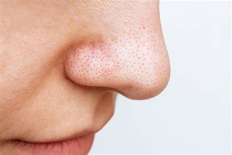 What causes pimples on the nose—and how to treat them