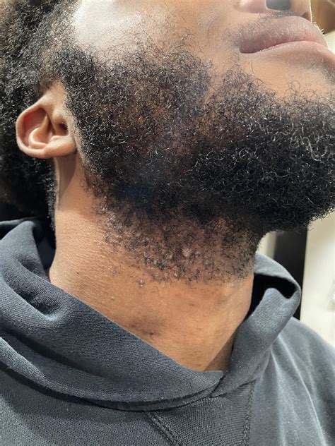 Ingrown Hair On Face Men FOREVER GONE MENS FACE ANTI INGROWN HAIRS
