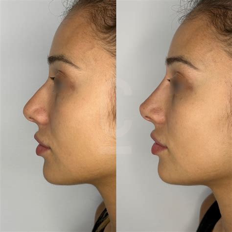 Rejuran Skin Rejuvenation Sydney & Melbourne | Cosmetic Connection