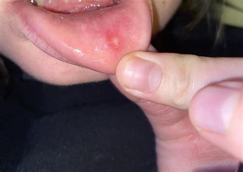 Is this herpes? I've had canker sores before,usually bellow my tongue, never cold sores. But ...