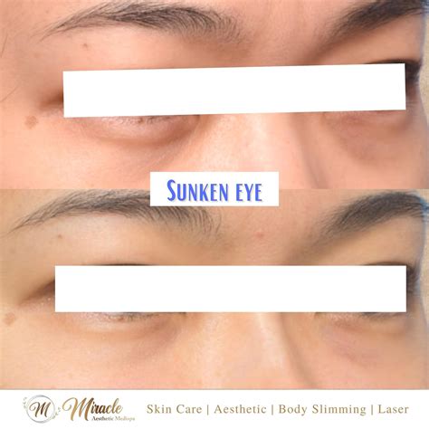 Sunken Eyes Dehydration