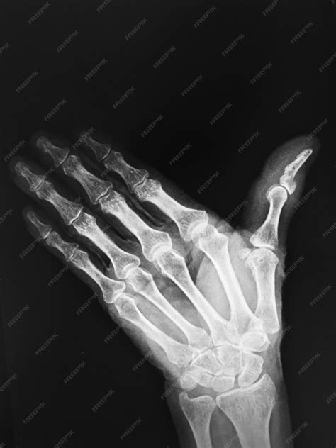 Broken Index Finger X Ray