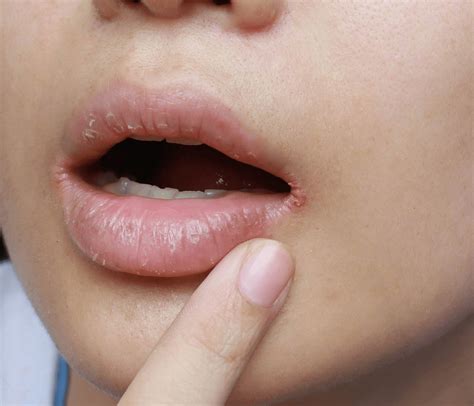 Angular Cheilitis, Penyebab Sudut Bibir Kering