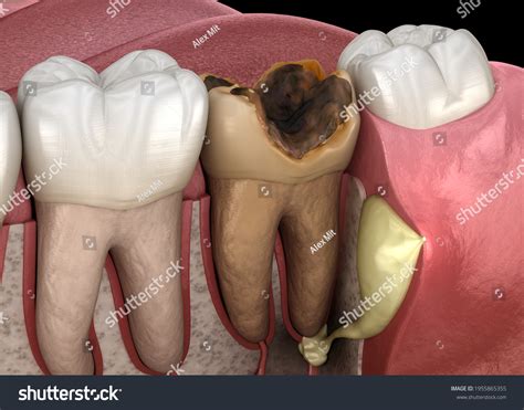 Periostitis Tooth Lump On Gum Above: ภาพประกอบสต็อก 1955865355
