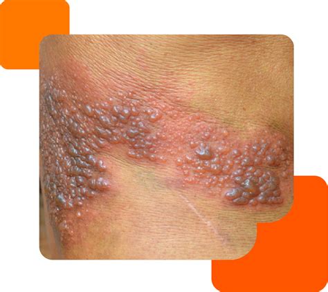 Etapas Del Herpes Labial Herpes Labial: Causas, Contagio, Síntomas Y