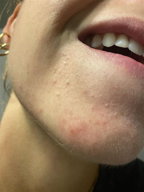 Small bumps below corners of mouth on chin : r/acne