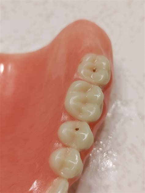 Are these tiny holes denture "cavities"? What can I do? I assume taking ...