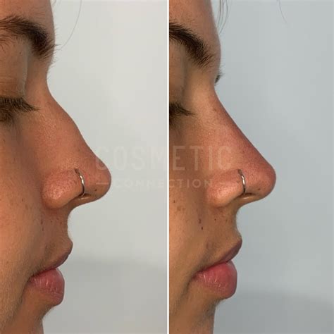 Rhinoplasty Logo Rhinoplasty Before And After Photos Dr. Robert Morin