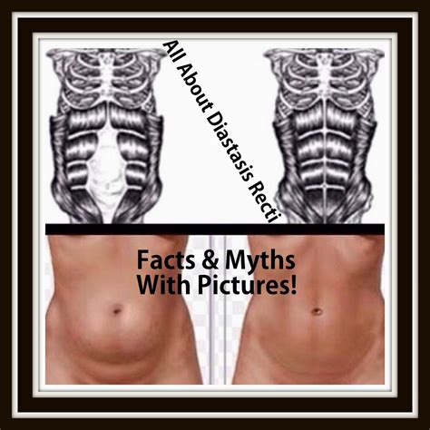 All About Diastasis Recti - Tons Of Facts & Myths Explained With ...