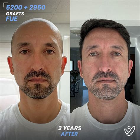 Hair Transplant vs. Hair Plugs: Which Is Right for You? - Estenove