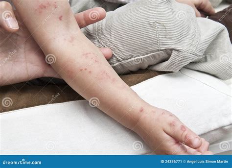 Blisters Caused By Shingles On Skin, Herpes Zoster Stock Photo | CartoonDealer.com #169880964