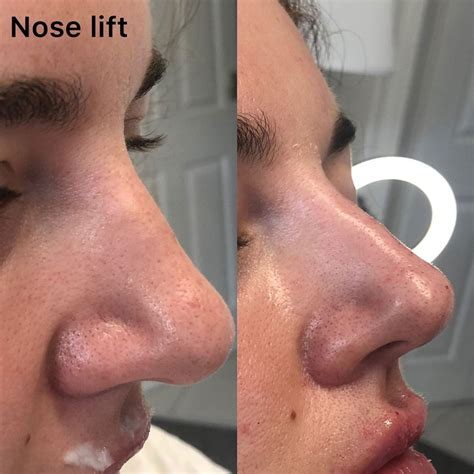 Non-Surgical Nose Job - Ness Aesthetics