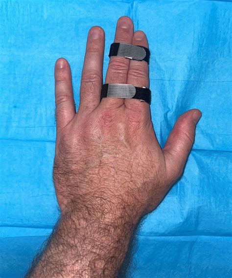 Finger Sprains - OrthoInfo - AAOS