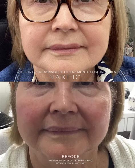 Sculptra® Filler & Injections for Natural Facial Volume – NAKEDMD Medspa