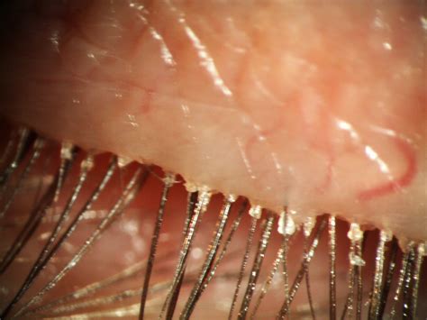 What Is Demodex And Blepharitis Lash Resource What is blepharitis ...