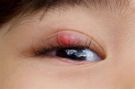 Small Stye On Eyelid