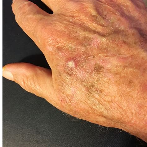Actinic Keratoses - Skin Health Institute
