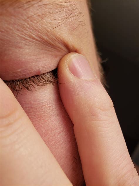 You've heard of an ingrown hair, but how about an ingrown eyelash? : r ...