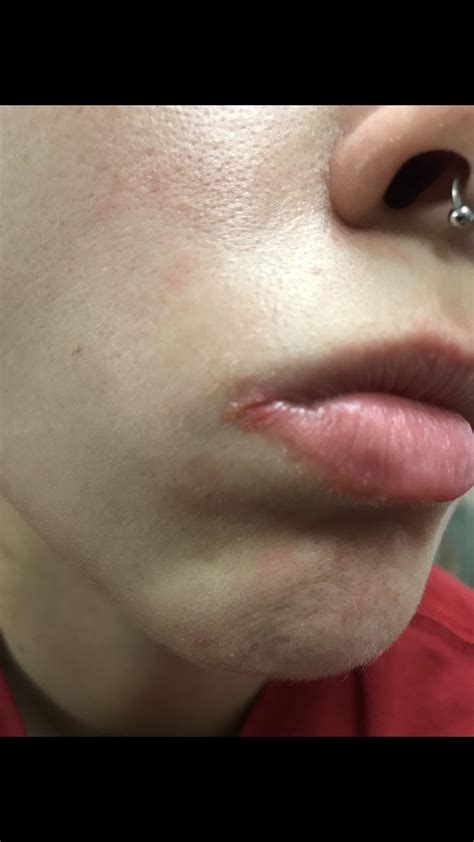 Have any of you dealt with the inner corner of your mouth splitting? A dermatologist (that a ...