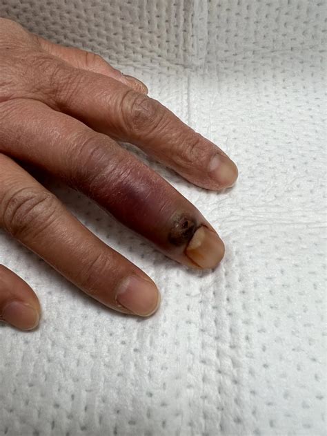 Finger Infection