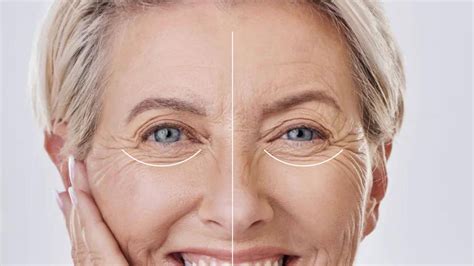 Under Eye Wrinkles Condition | Best Aesthetic Treatments Swindon