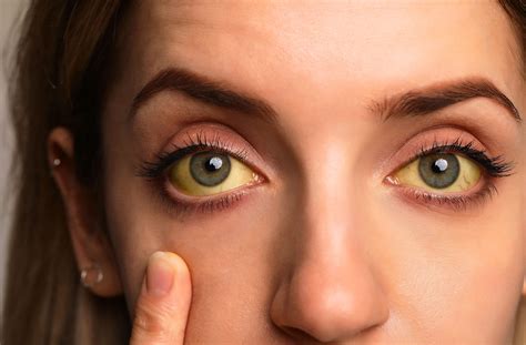 Yellow Eyes: Causes and Treatments – Iris