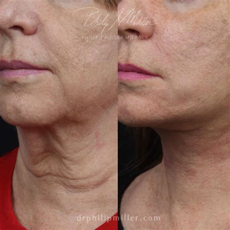 Tech Neck Lines Treatment in New York - Philip Miller MD