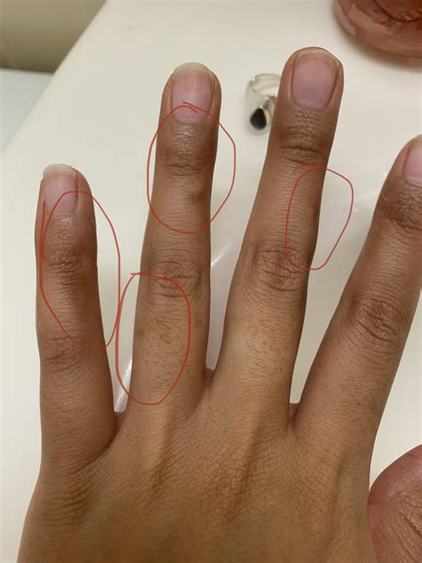 My hands developed these brown spots over the span of an hour. They won ...