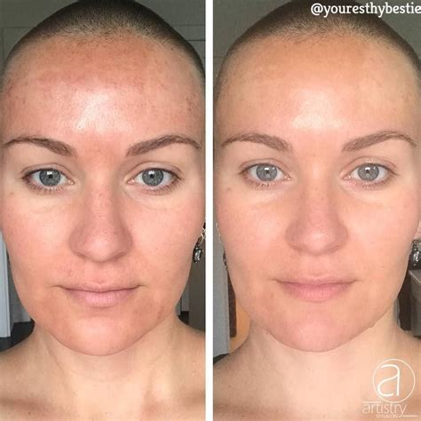 Microneedling Before And After Pictures | Before And After